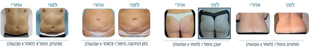 תמונות לפני אחרי הקפאת שומן 