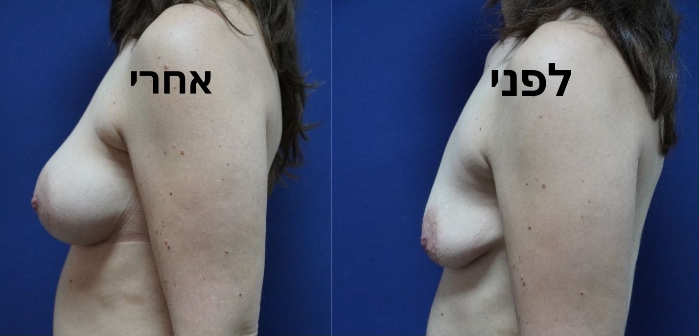 לפני ואחרי הגדלת חזה עם שתלי סיליקון