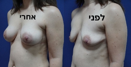 הגדלת חזה עם שתלי סיליקון דר איציקסון