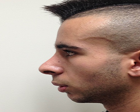 ניתוח אף אחרי