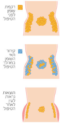 התהליך בגוף לפני ואחרי המסת השומן