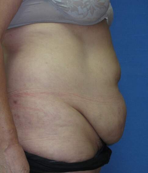 צילום פרופיל של מטופלת מספר 1 לפני ניתוח מתיחת בטן 