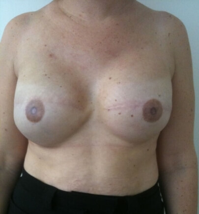 צילום של מטופלת אחרי ניתוח לשחזור שד