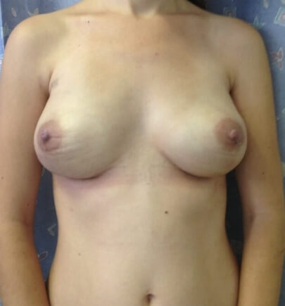 תמונה חזיתית אחרי ניתוח לשחזור השד