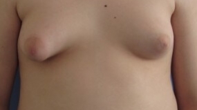 Gynecomastia Dr. Itzikson